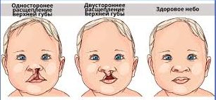«Заячья губа» у новорожденных